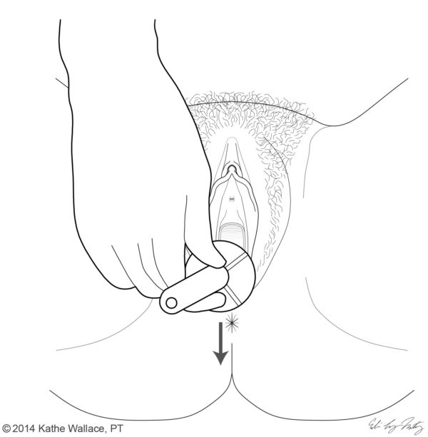 Vaginal Dilator Kit: The Four Part Guide by Kathe Wallace - Image 2