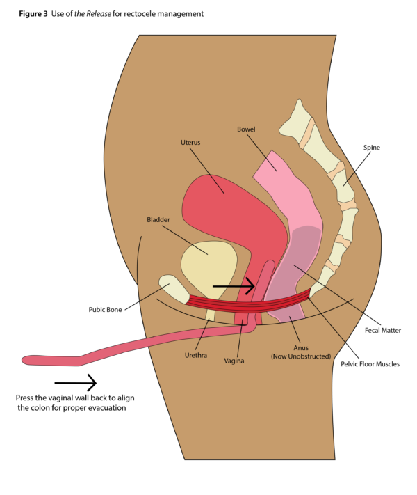 Release Rectocle Splint Tool Figure 3