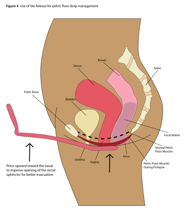 Release Rectocele Splint Tool Figure 4