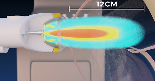 Benefits of SoftWave Shockwave Therapy for Your Practice